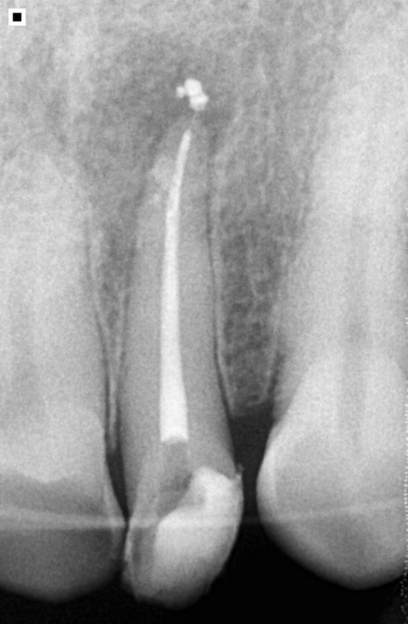 Conductometría endodoncia uniradicular
